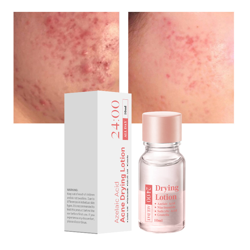 Salicylsäure Flecken-Trocknungs-Lotion – Zielgerichtete Mitesserbehandlung für klarere Haut