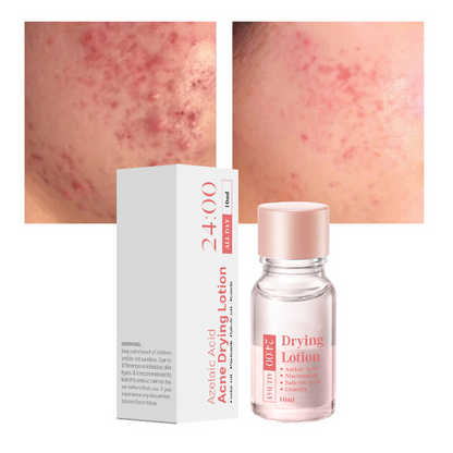 Salicylsäure Flecken-Trocknungs-Lotion – Zielgerichtete Mitesserbehandlung für klarere Haut