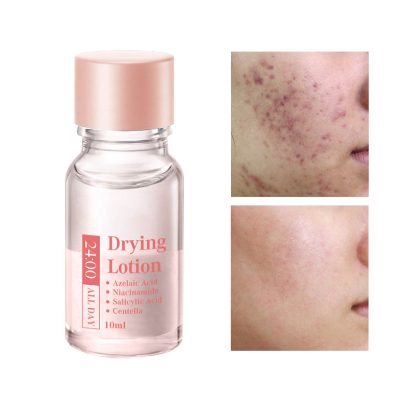 Salicylsäure Flecken-Trocknungs-Lotion – Zielgerichtete Mitesserbehandlung für klarere Haut