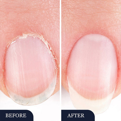✨Neuheiten🔥Feder zur Behandlung von Nagelpilz bei beschädigten Nägeln